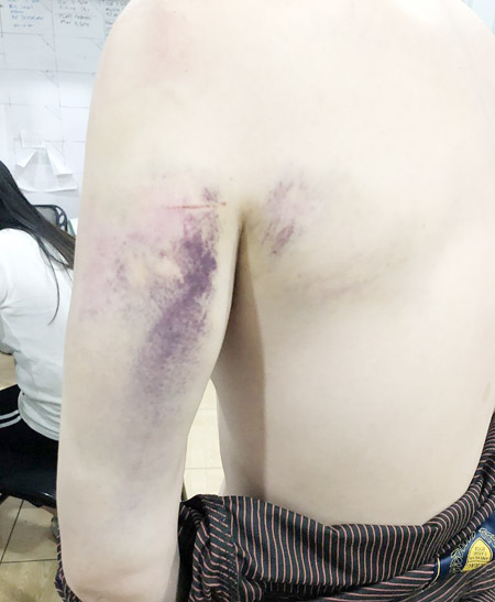 一名台灣男子向菲博彩公司求職後遭綁架勒索，對方毆打凌虐這名男子，導致他左肩、左背、手臂大片瘀青。