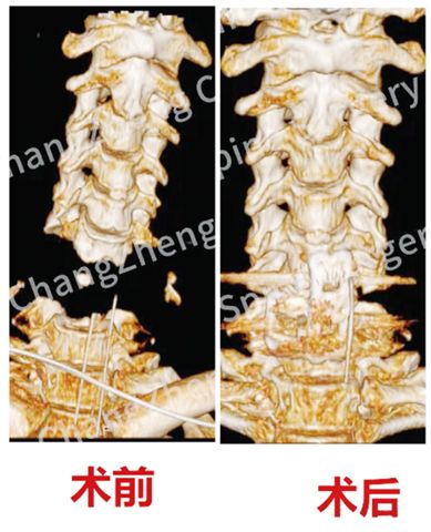 影像檢查顯示患者頸椎罕見大跨度脫落。