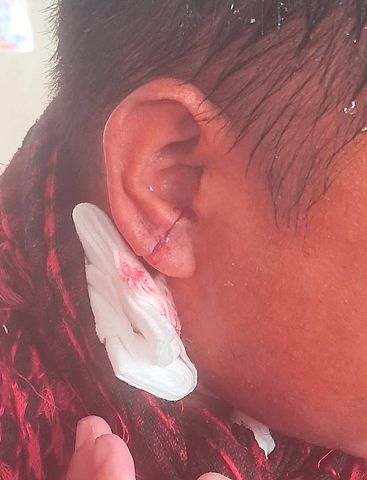 此資料照片顯示2025年9月16日黃岩島附近水炮事件中受傷的菲漁業與水產資源局人員。