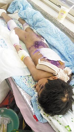 10岁女孩上国学班遭虐待 针扎指甲锁骨被踩